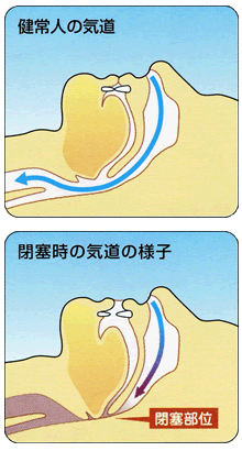 気道の様子